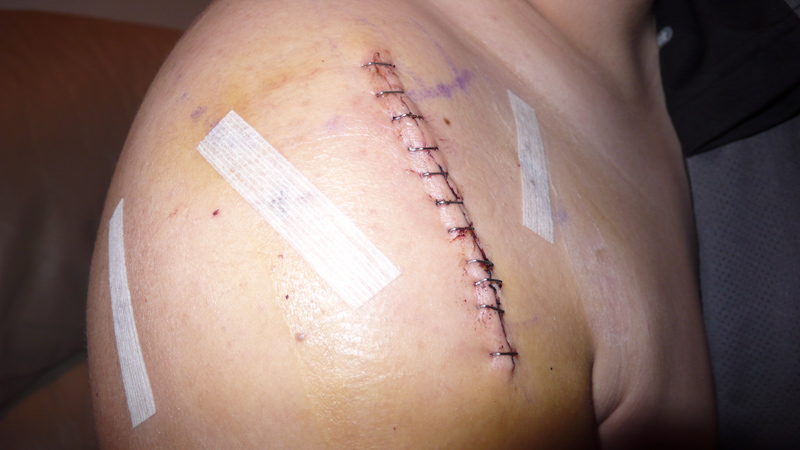 What-is-Shoulder-Surgery